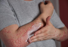 Blisterata: What Is It? Complete Guide Blisterata