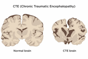 CTE