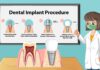 Dental Implant Options: Making Informed Choices Dental Implant
