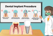 Dental Implant Options: Making Informed Choices Dental Implant