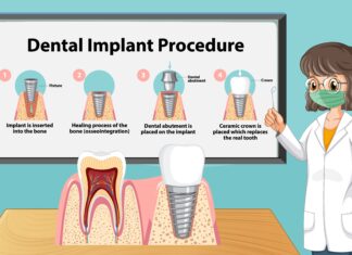 Dental Implant Options: Making Informed Choices Dental Implant