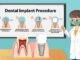 Dental Implant Options: Making Informed Choices Dental Implant