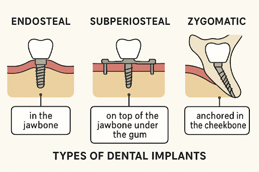Dental Implant