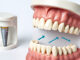 A Practical Guide to Full-Mouth Dental Implants Dental Implants