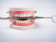 The Road to a Perfect Smile: All About Dental Implants Dental Implants