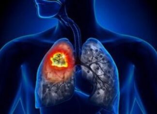 The Importance of Biomarker Testing in Non-Small Cell Lung Cancer Clinical Trials Lung Cancer