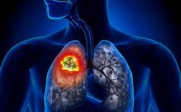 The Importance of Biomarker Testing in Non-Small Cell Lung Cancer Clinical Trials Lung Cancer