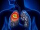 The Importance of Biomarker Testing in Non-Small Cell Lung Cancer Clinical Trials Lung Cancer
