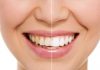 What Are The Techniques Used In Cosmetic Dentistry