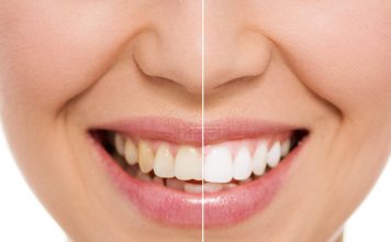 What Are The Techniques Used In Cosmetic Dentistry