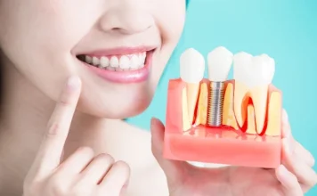 Full Arch Implants: Restoring Smiles with Complete Dental Solutions Dental Solutions